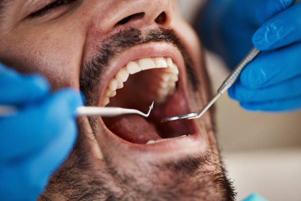 Best Emergency Dental Extractions in Pontoon Beach, IL